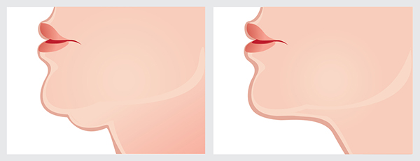 grafica doppio mento prima e dopo utilizzo crema doppio mento